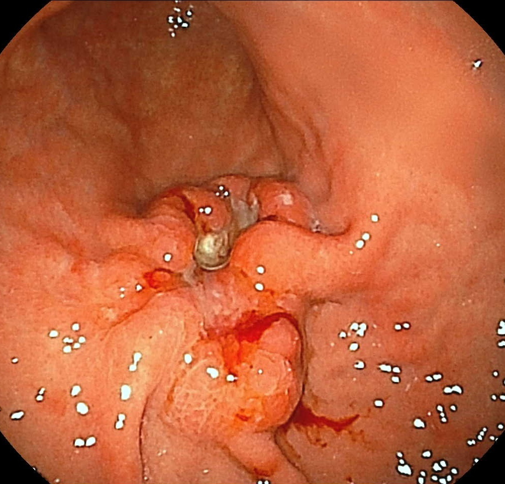 胃癌の写真