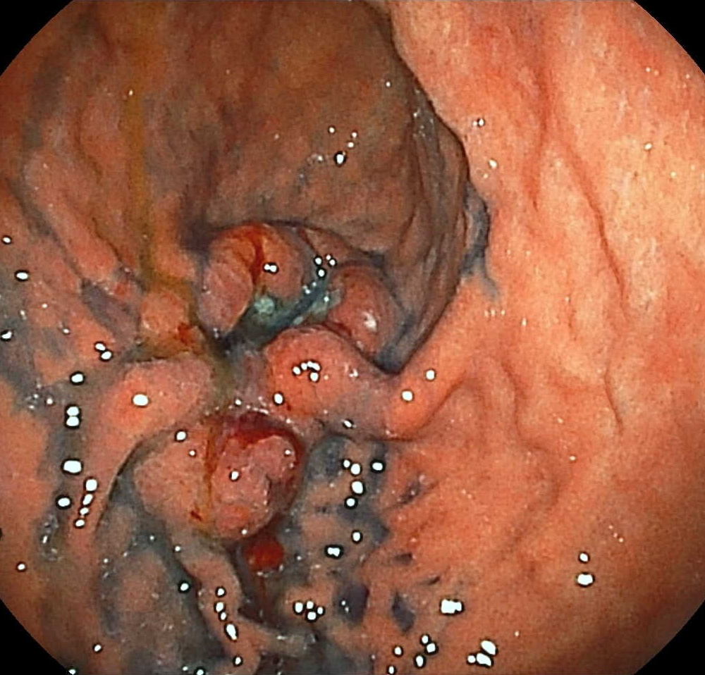 胃ガン写真-染色
